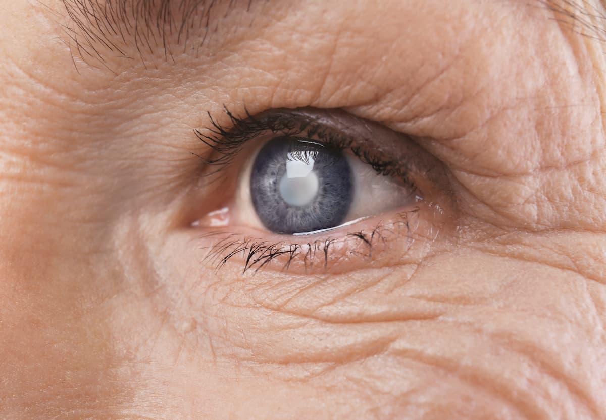 An eye plagued by cataracts looks ahead as Southwest Eyecare explains the procedures they offer to fix cataracts