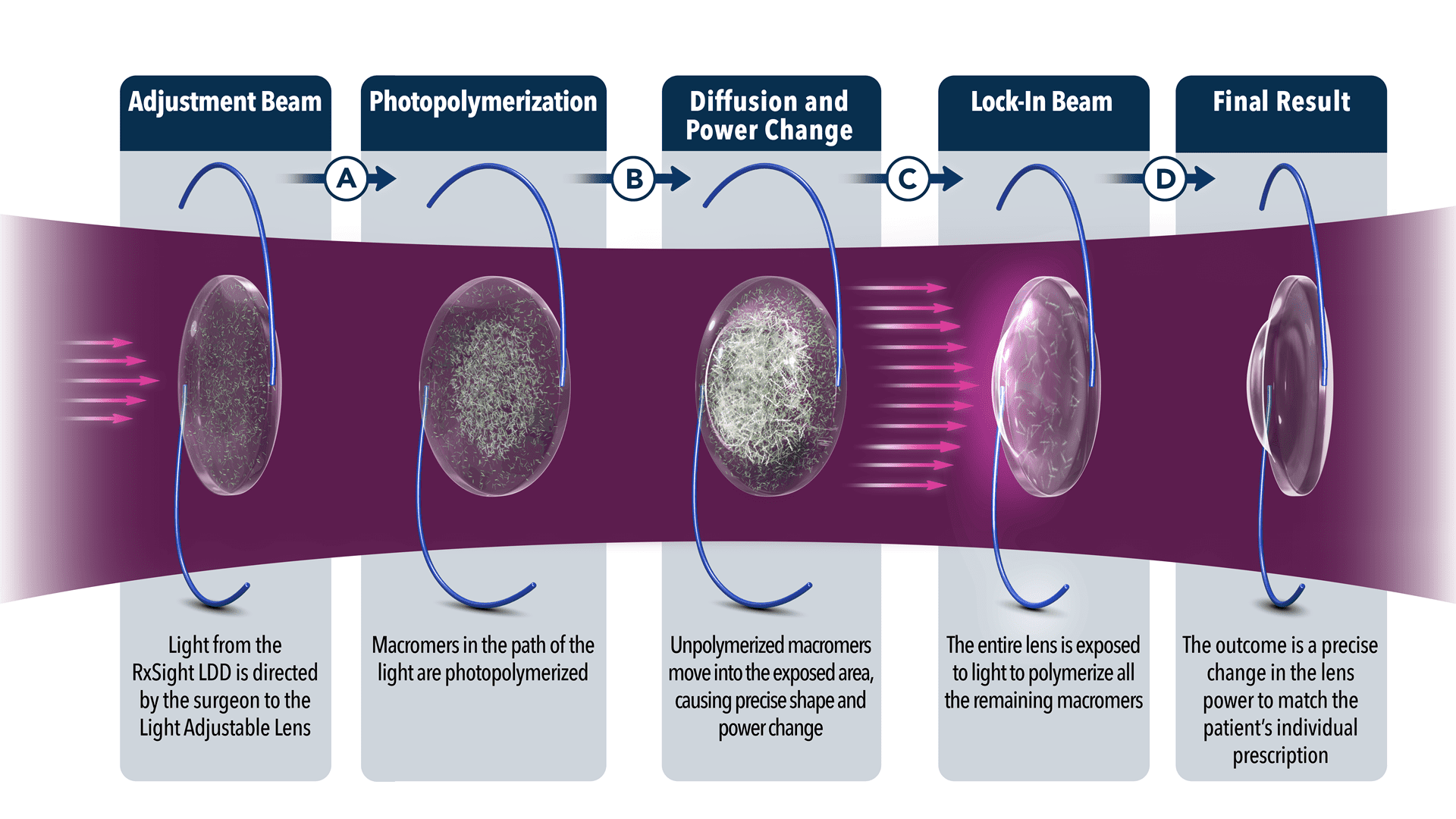 Image outlining how Light Adjustable Lenses work